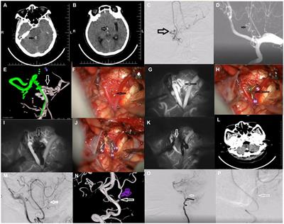 Resection of ruptured aneurysm associated with bilateral anomalous posterior inferior cerebellar anastomotic arteries: case report and review of literature